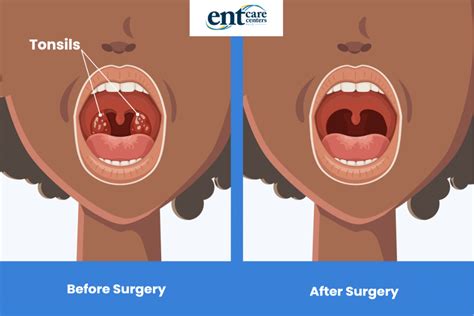 Tonsil removal surgery in children