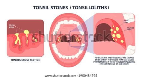 tonsil stone and sore throat
