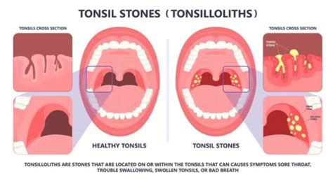 Tonsil stone complications and risks