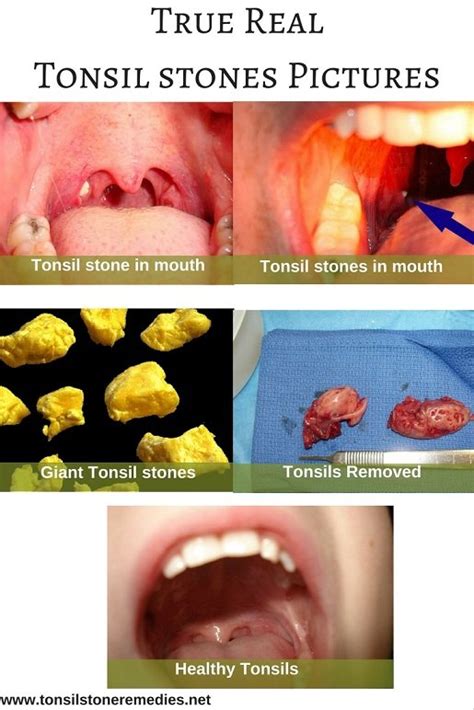 Tonsil stone conclusion and next steps