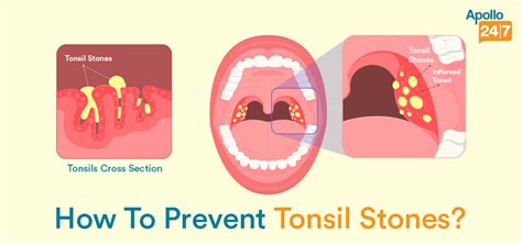 Tonsil stone prevention
