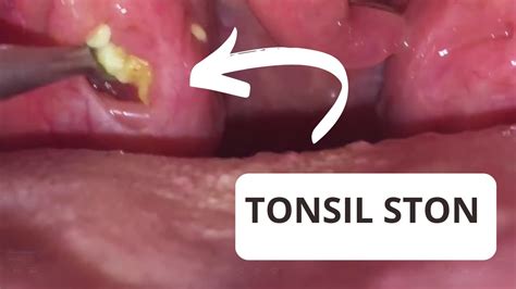 tonsil stone removal