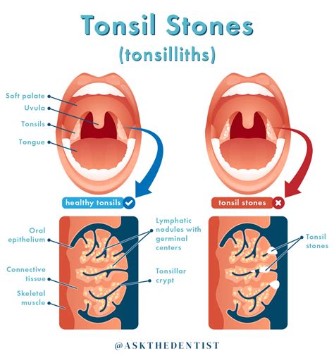 tonsil stone symptoms
