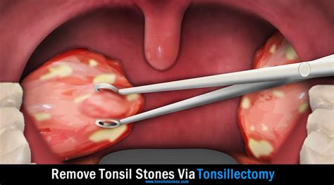 tonsil stones