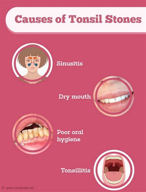 tonsil stones causes