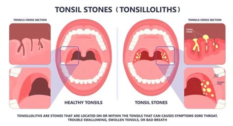 tonsil stones complications