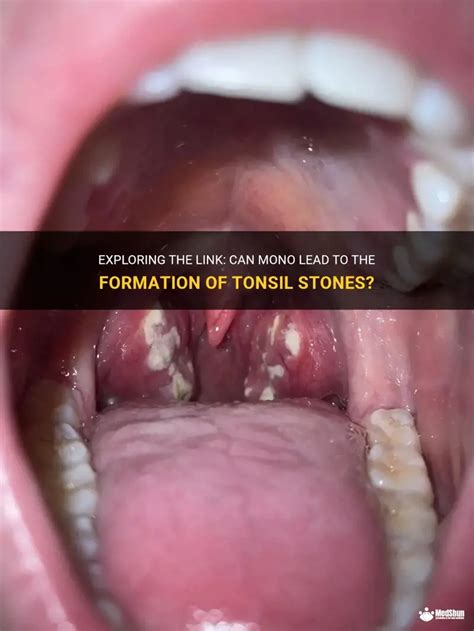 tonsil stones formation