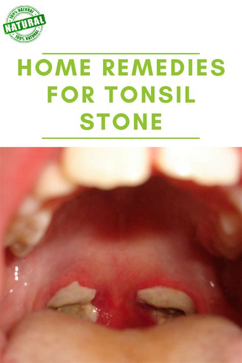 tonsil stones treatment