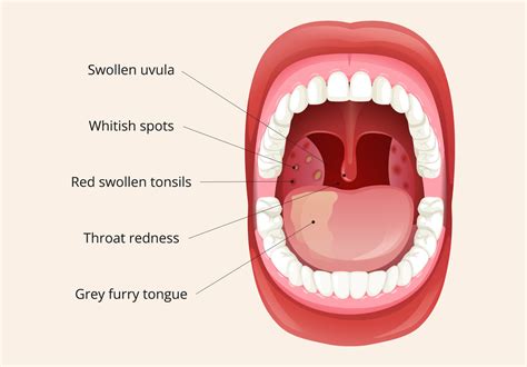 tonsillitis