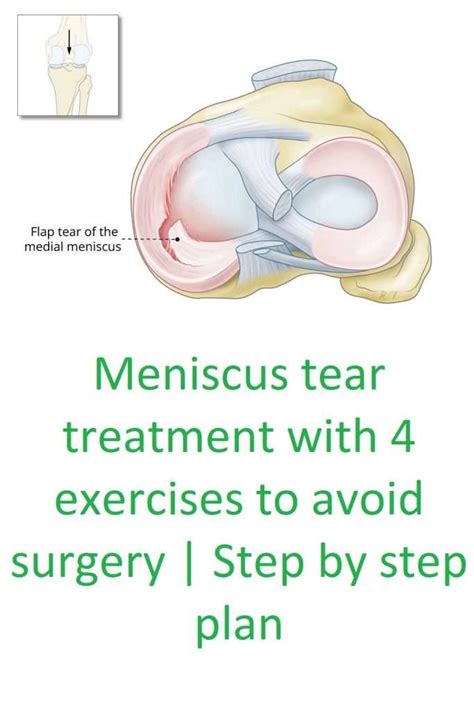 Torn Meniscus Treatment Options