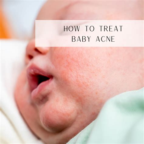 treating baby acne