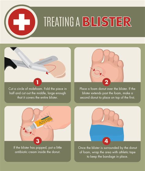 treating blisters
