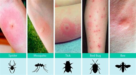 treating bug bites