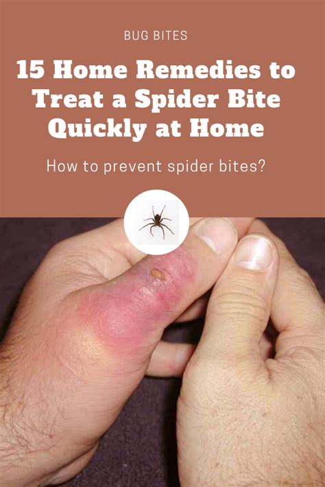 Treating Severe Spider Bites