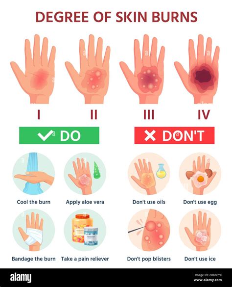 Treatment for second degree burns