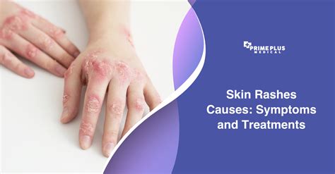 treatment for specific rashes