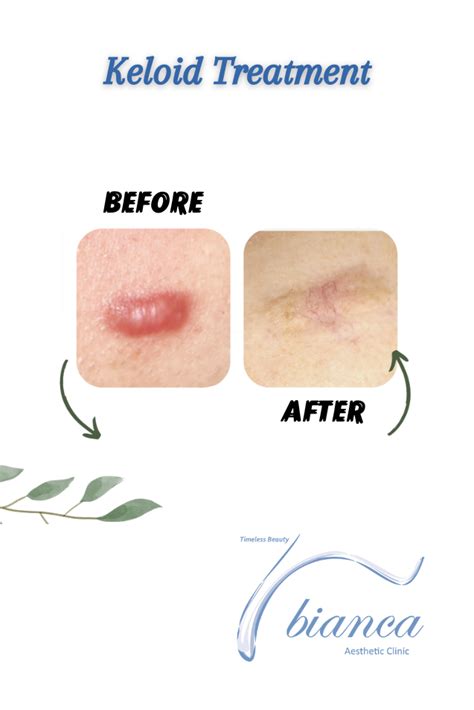 Treatment Options for Keloid Scars