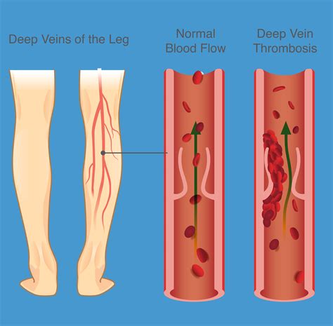 Treatment of Leg Vein Thrombosis