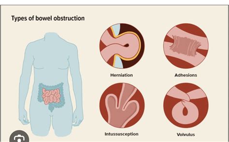 treatment of small bowel obstruction