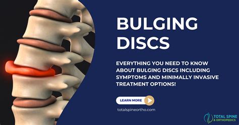 Treatment Options for a Bulging Disc