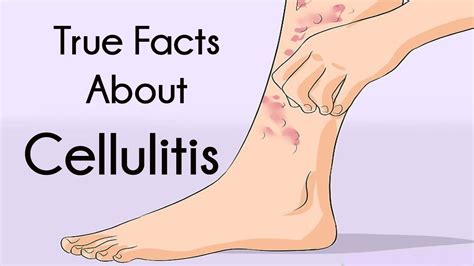 treatment options for cellulitis on feet