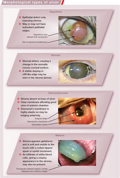 Treatment Options for Eye Ulcers