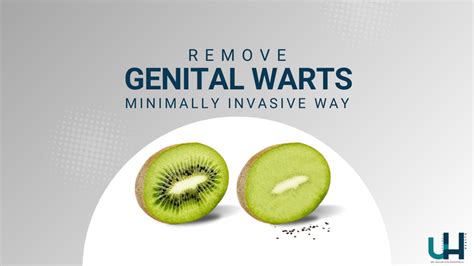 Treatment Options for Genital Warts