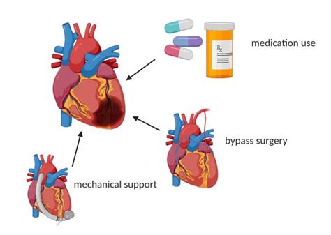 treatment options for heart attacks