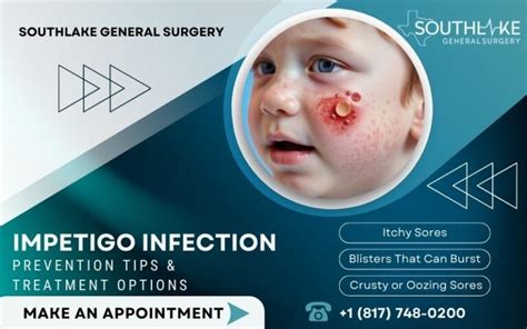 Treatment Options for Impetigo