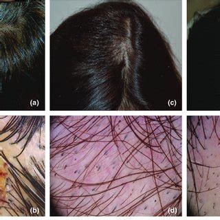 Treatment Options for Lichen Simplex Chronicus