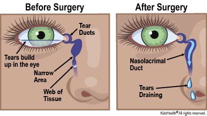 treatment options for newborn tear duct obstruction