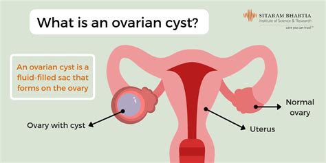 Treatment Options for Ovarian Cyst Discharge