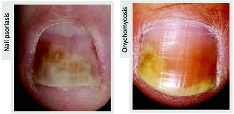 Treatment Options for Psoriatic Nail Disease