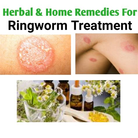 Treatment Options for Ringworm