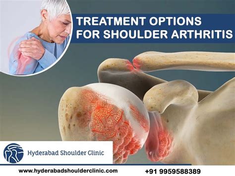 Treatment Options for Shoulder Injuries