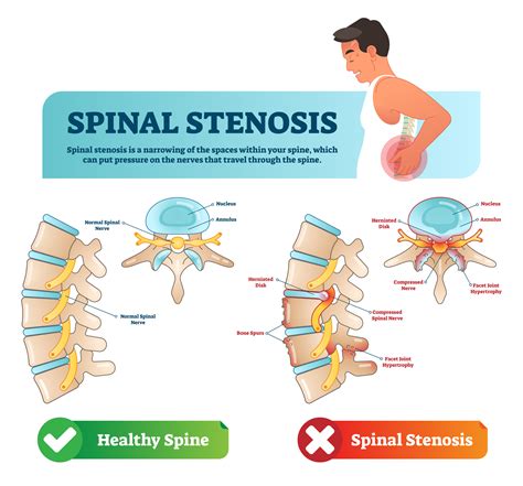 Treatment Options for Spinal Conditions