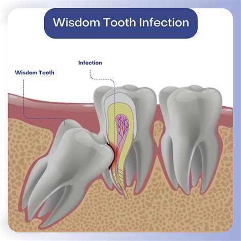 Treatment options for wisdom teeth issues