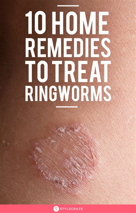 treatment for ringworm
