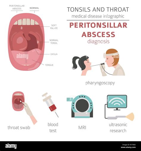 Treatment for Throat Abscess