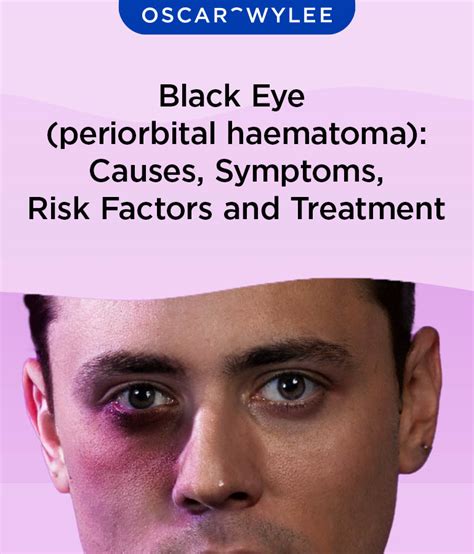 Treatments for Black Eye