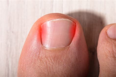 treatments for toe nail bed pain