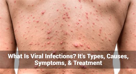 Treatments for Viral Infections