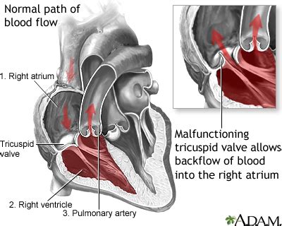 tricuspid valve regurgitation