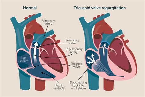 tricuspid valve regurgitation diagnosis