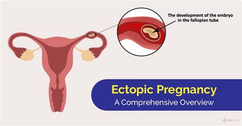 Tubal Ectopic Pregnancy Causes