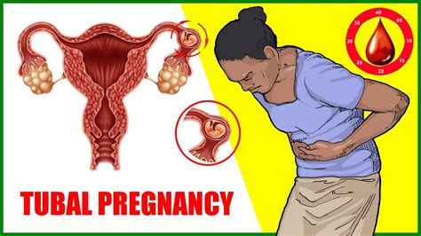 Tubal Ectopic Pregnancy Symptoms