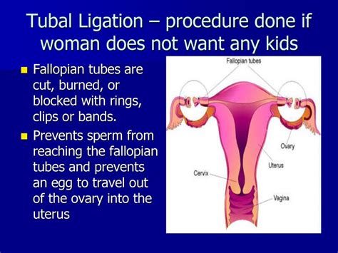 Tubal Ligation Procedure