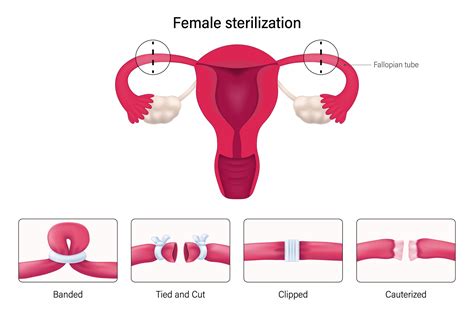 Tubal Ligation Procedure