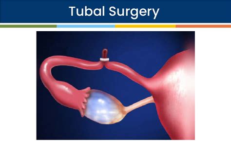 Tubal Removal Surgery Procedure Steps