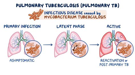 Tuberculosis
